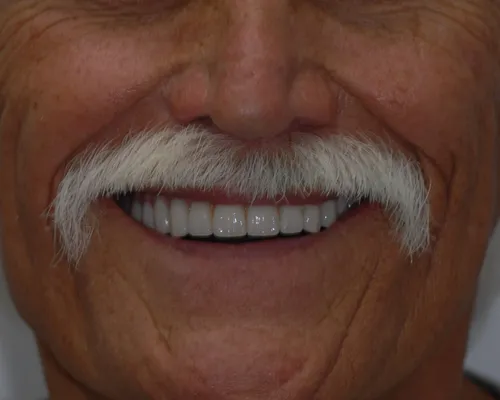 After All-on-X full arch restoration