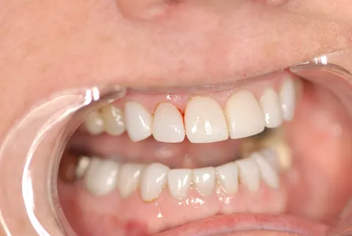 After porcelain crown restoration