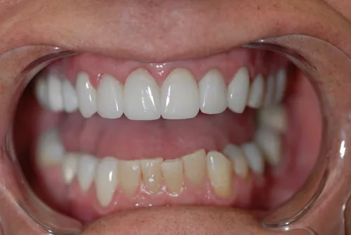 After full smile restoration with crowns