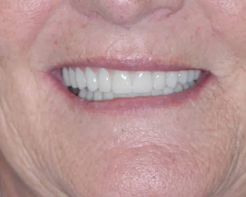 After denture replacement