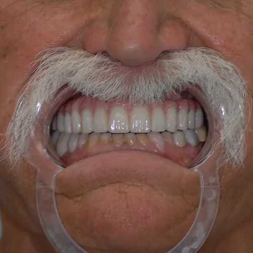 After full smile makeover
