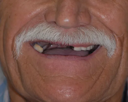 Before All-on-X full arch restoration