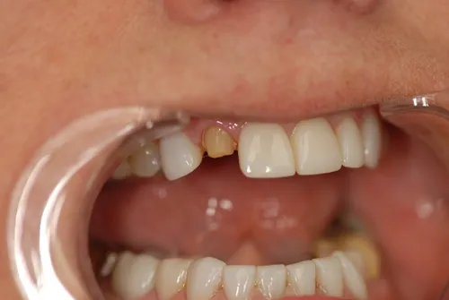 Before porcelain crown restoration