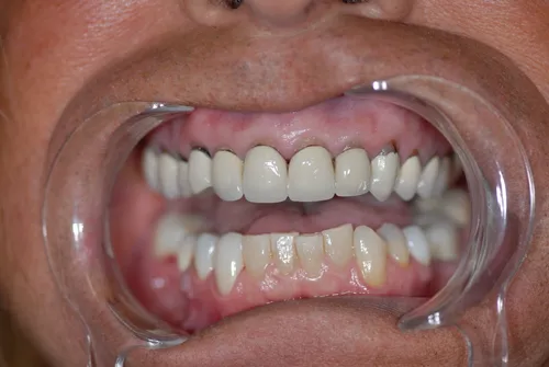 Before full smile restoration with crowns