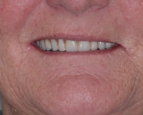 Before denture replacement