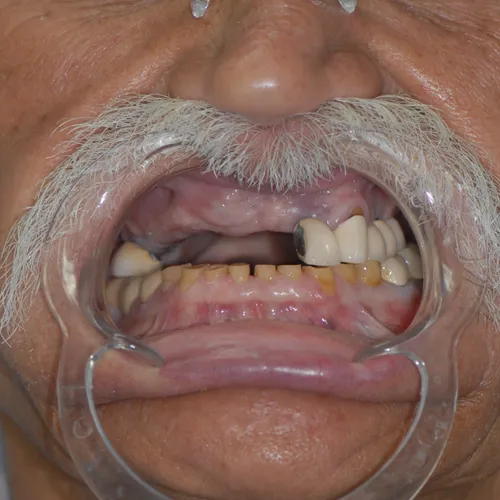 Before full smile makeover