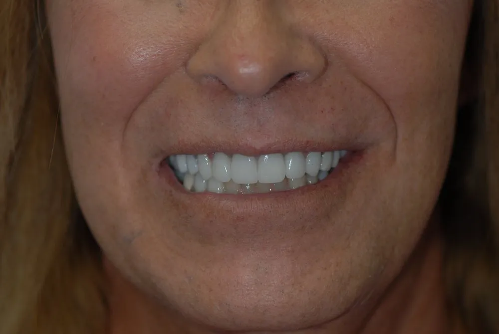 Natural-looking dental crowns